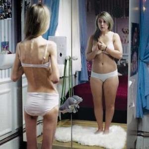 Anorexia