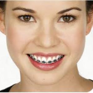 Braces-Good or Bad