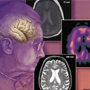 Is Dementia (Alzheimers) a rising issue in this world?