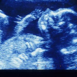 Abortions 